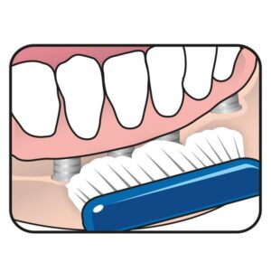 implantortho_illustration_04