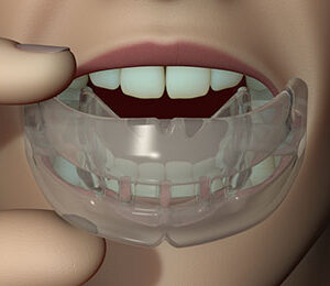 MRC myOSA TMJ-BDS S1 norskajatele