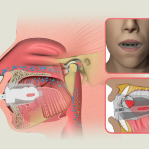 the myosa sys