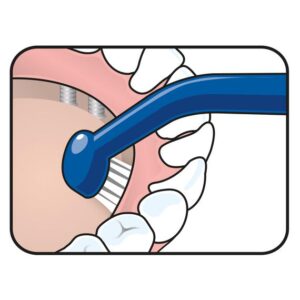 univesal implant