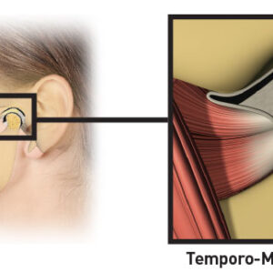 MRC myOSA for TMJ soft clear