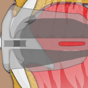 MRC myOSA TMJ-BDS S1 Mouldable