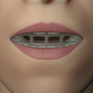 MRC myOSA TMJ-BDS S1 Mouldable